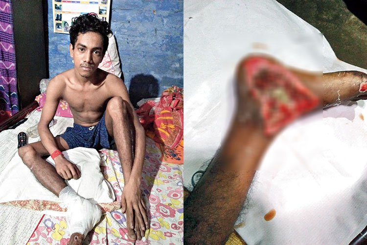 Kolkata: Youth denied admission in two major government hospitals, faces the risk of losing a leg