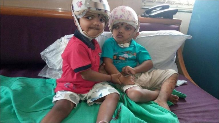 First in India: Jagga and Balia, conjoined twins born with brains fused, separated successfully by doctors at AIIMS