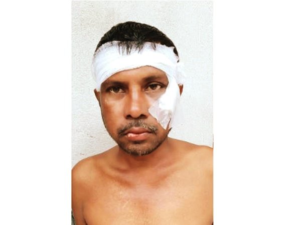 West Bengal: TMC worker injured after being beaten up by fellow worker for chanting ‘Jai Shree Ram’