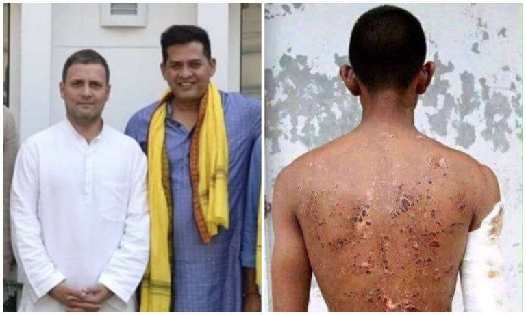‘Vyapam whistleblower’ and Congress sympathiser doctor shares fake image of ‘brutality of Chinese forces on unarmed Indian soldiers’