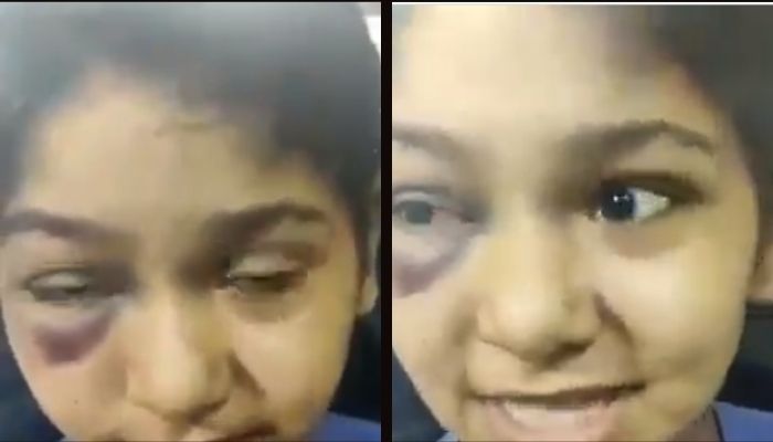 We were being beaten by TMC workers: Girl attacked and bruised while trying to save her father and uncle from TMC goons, BJP shares viral video