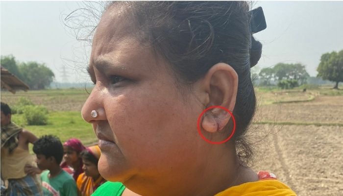 West Bengal: TMC goons attack BJP worker, tears the earlobe of his mother when she tried to protect her son from attack