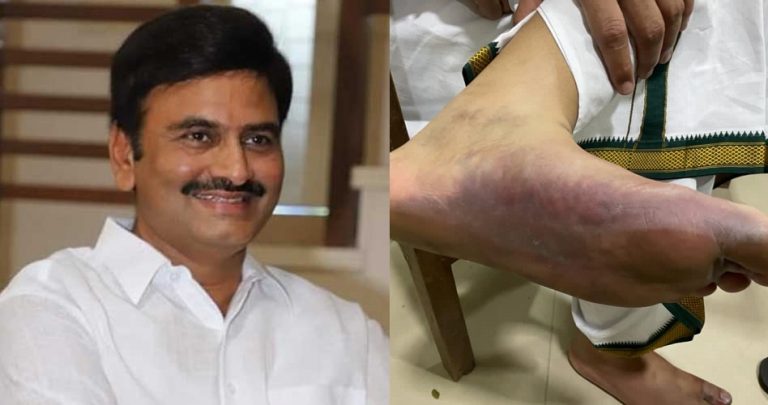 Rebel YRS Congress MP who was arrested for criticising Andhra CM Jagan Reddy tortured in custody, images of injuries go viral