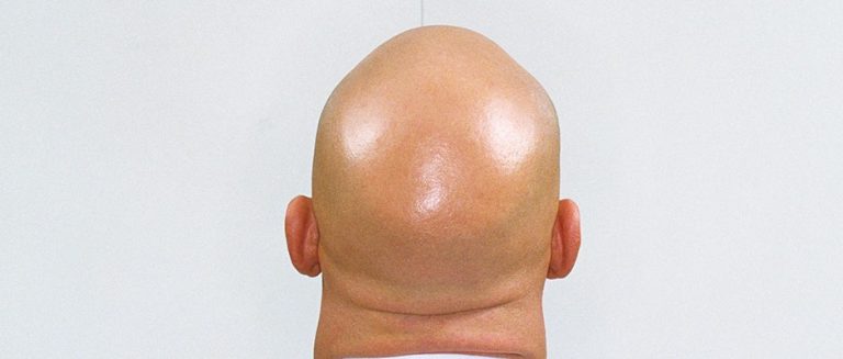 Calling a man ‘bald’ is sexual harassment: UK employment tribunal