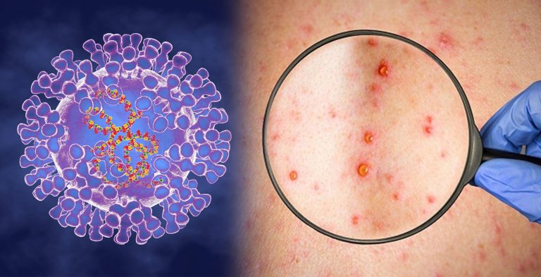 Europe, US on alert over detection of Monkeypox cases: What is the virus, symptoms and its transmission across the globe