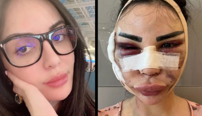 Brazilian-born model who spent 12 years looking like Kim Kardashian finally undergoes detransition. Here is how it turned out