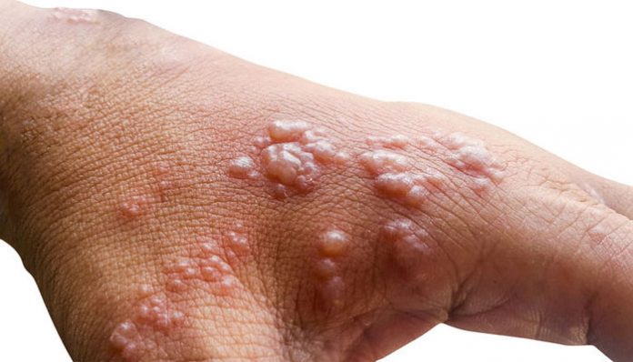 Kerala confirmed second case of Monekypox