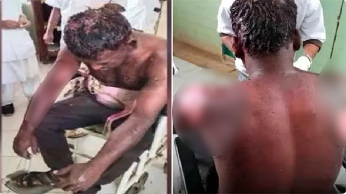 Telangana: Mohammed Shabbir sets Hindu man on fire by pouring petrol for applying Holi colours on him