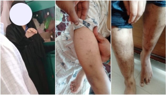 Maharashtra: Hindu minor abducted, raped, given lit cigarette bruises on body by Javed Sheikh