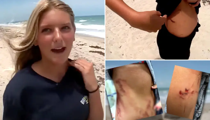 USA: 13-year-old girl thwarts a shark attack at Florida beach, gets bitten in the stomach, arm, knee and finger
