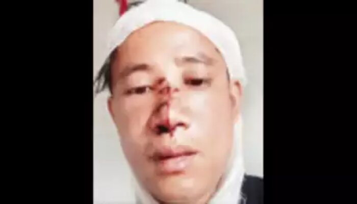 They called me Chinese: 30-year-old man from Sikkim attacked by 3 people in Bengaluru’s Neeladri Nagar