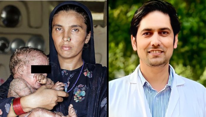Child with skin disease presented as burn victim to solicit funds from public on Ketto, army doctor exposes ‘scam’ by one Qamar Ali