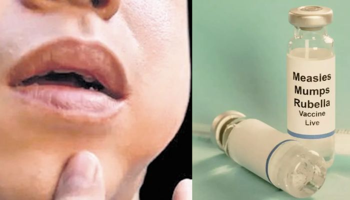 Mumps outbreak in Kerala: 10,000 cases in last 70 days, outbreak spreading due to lack of vaccination