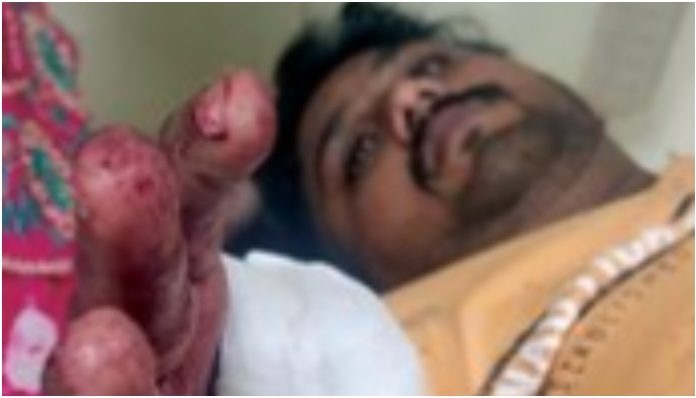 Pune: Salman, Sultan, Aslam, 6 others launch deadly attack on Akshay Dhavre for working as Hindu Dalit activist, cut his thumb off; 3 arrests claimed