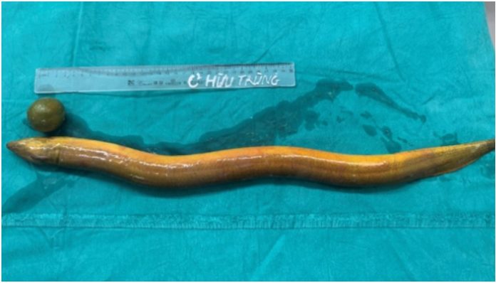 Indian man in Vietnam inserts live eel up his rear; saved after doctors removed 65cm long creature through anus