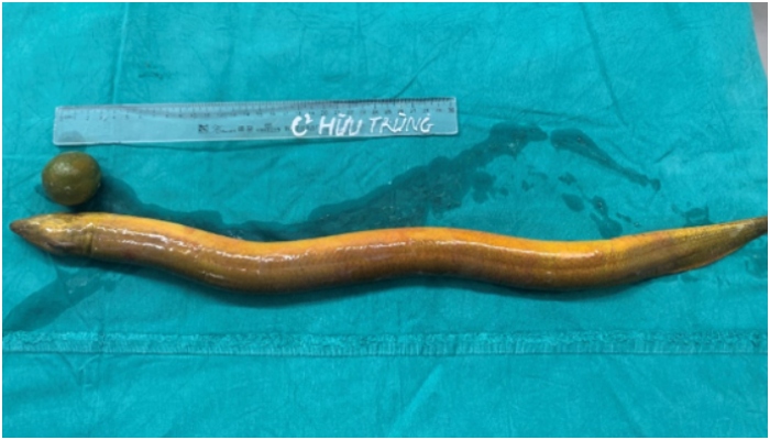 Indian man in Vietnam inserts live eel up his rectum as a ‘sex toy’: Doctors remove 65cm long creature after emergency abdominal surgery