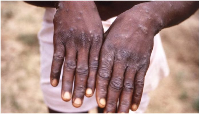 Pakistan: At least three patients of Monkeypox confirmed in Peshawar, infected believed to have arrived from Arab countries