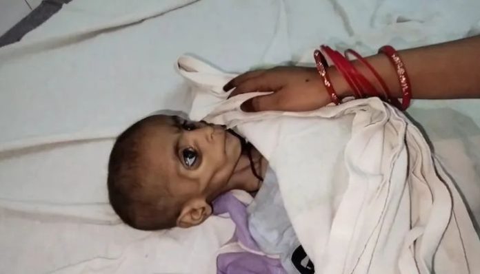 MP child dies of Malnutrition